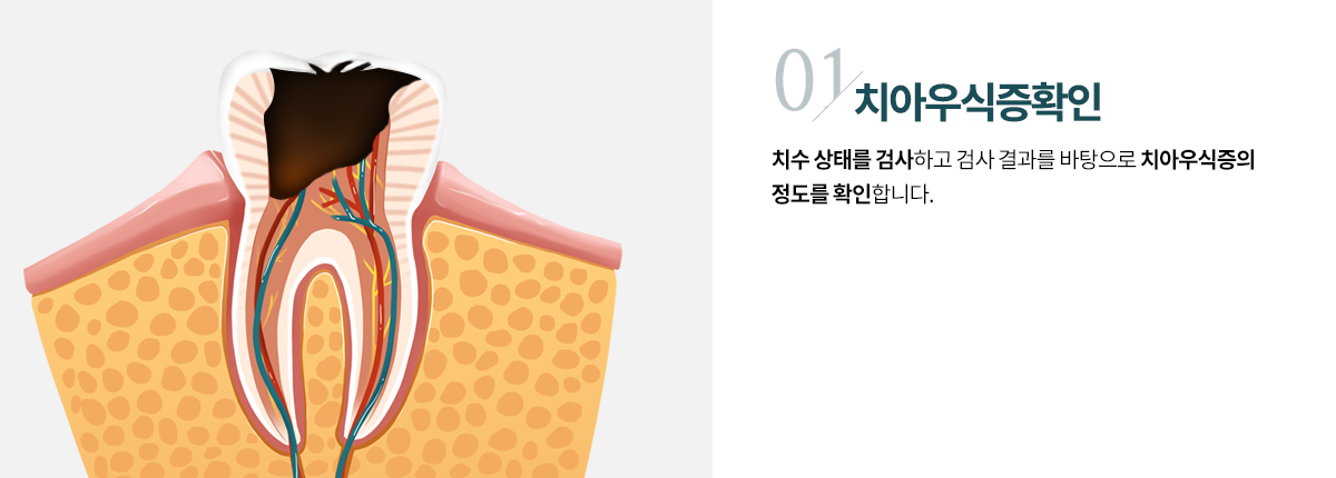 치아우식증확인